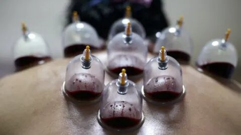 Wet Cupping