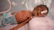 یمن میں روزانہ 80 سے زائد بچے پیدائش کے وقت ہی مر جاتے ہیں