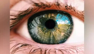  ایران تنها تولیدکننده ایمپلنت چشمی در جهان