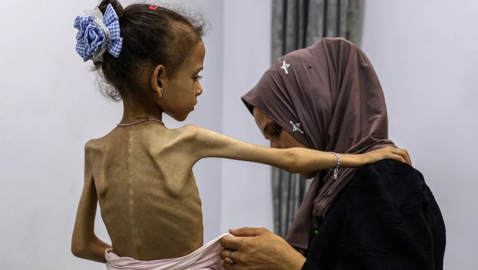 صحة غزة في يوم الأغذية العالمي: 466 حالة وفاة بينهم 157 طفلاً منذ 2024 بفعل التجويع